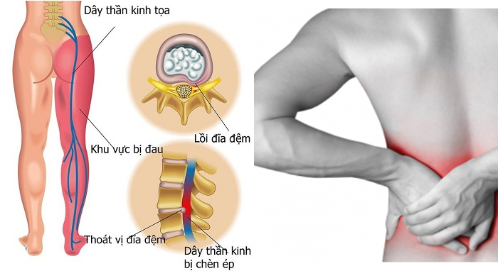 Thoát vị đĩa đệm làm đau dây thần kinh tọa