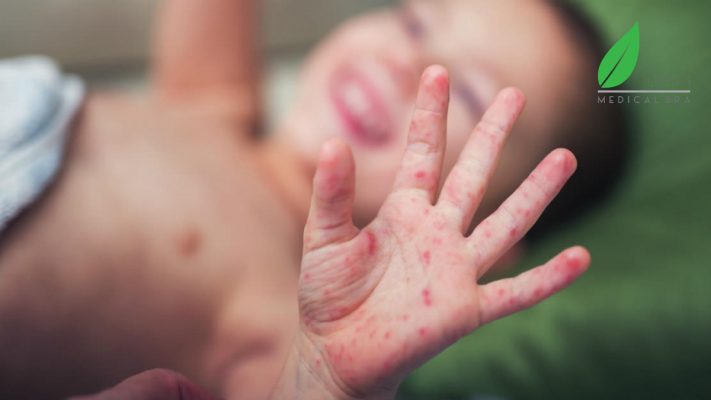 Con cái bị nhiễm bệnh, phụ huynh cũng dễ bị stress vì lo lắng