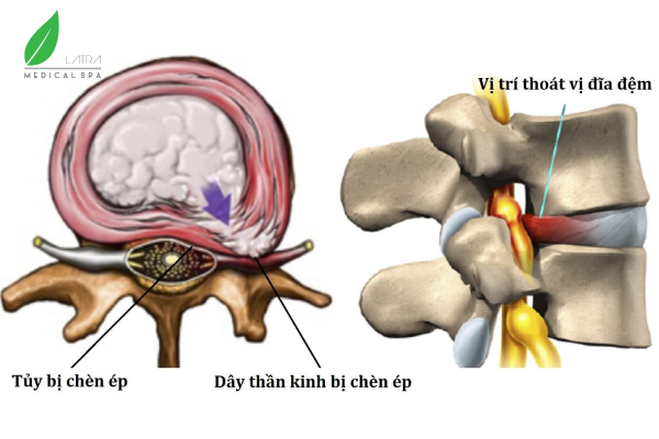 Thoát vị đĩa đệm gây đau nhức do tủy và dây thần kinh bị chèn ép