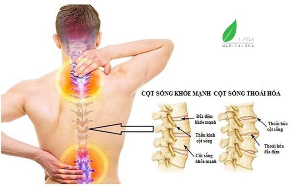 Bệnh thoái hóa cột sống