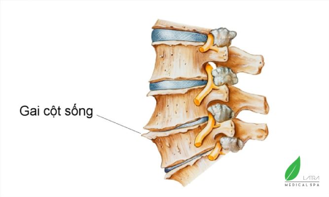 Gai cột sống: Đau ở vùng thắt lưng kèm theo tình trạng đau một bên đùi, mông