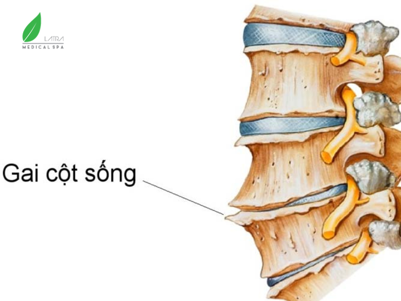 Bên ngoài hoặc hai bên cột sống hình thành các gai xương