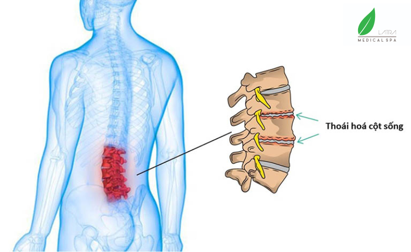 Thoái hóa cột sống