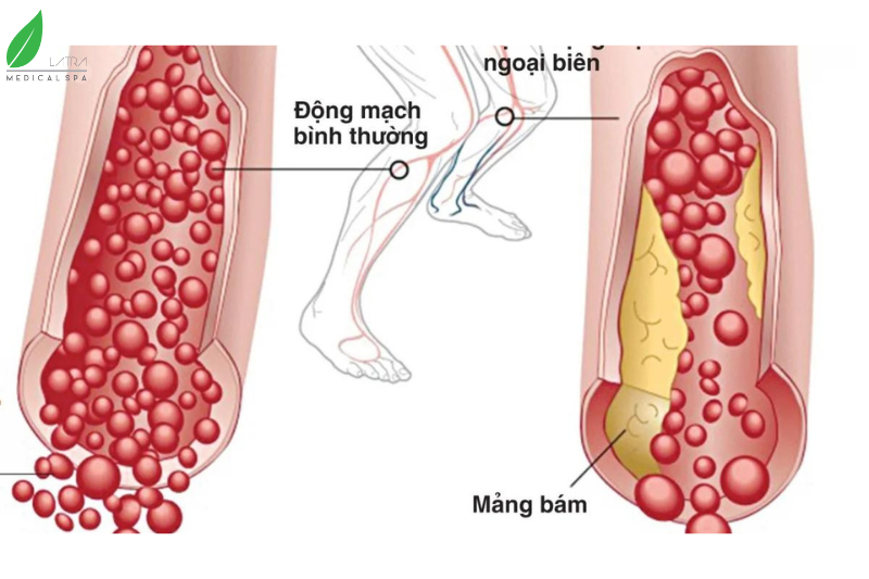 Bệnh động mạch ngoại biên (PAD)