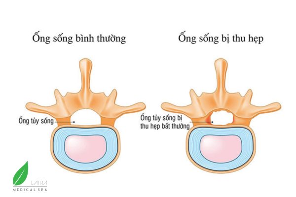 Bị đau nhức chân tay là cảnh báo bệnh gì? Hẹp ống sống