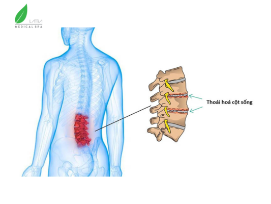  Thoái hóa đốt sống là một trong những nguyên nhân hàng đầu gây ra gai cột sống