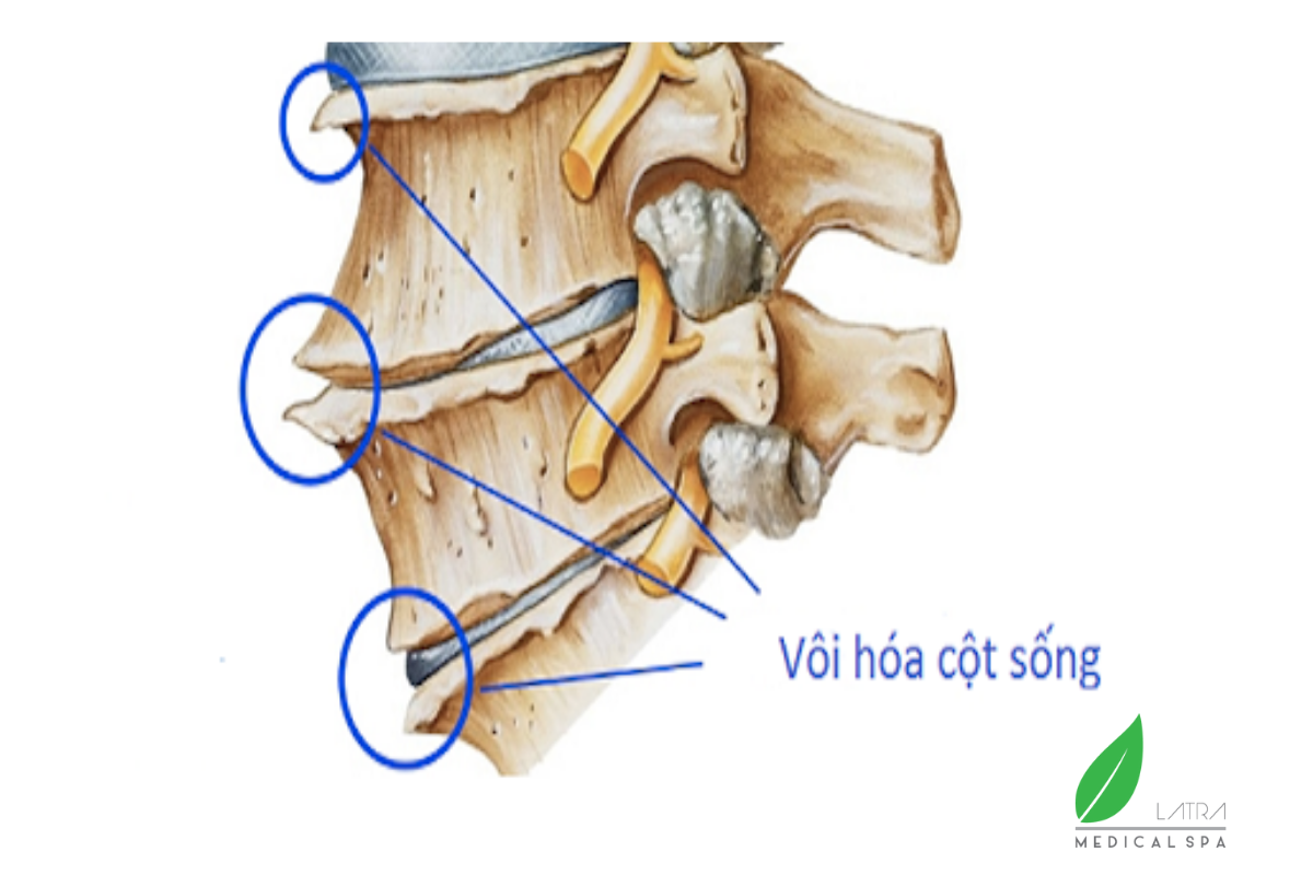 Bệnh vôi hóa cột sống