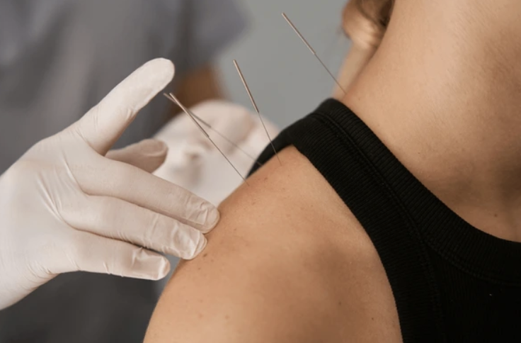 Cứu huyệt điều trị